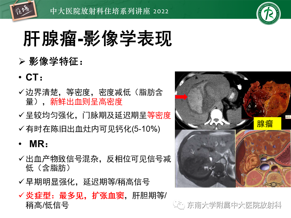 影像PPT - 【PPT】肝脏出血性病变的影像诊断及鉴别诊断-57