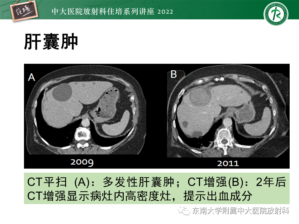 影像PPT - 【PPT】肝脏出血性病变的影像诊断及鉴别诊断-64