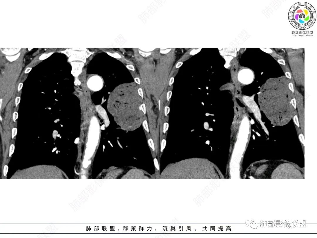 影像PPT - 【病例】肺部硕大块影一定想到它!-30 影像PPT - 【病例】肺部硕大块影一定想到它!-30