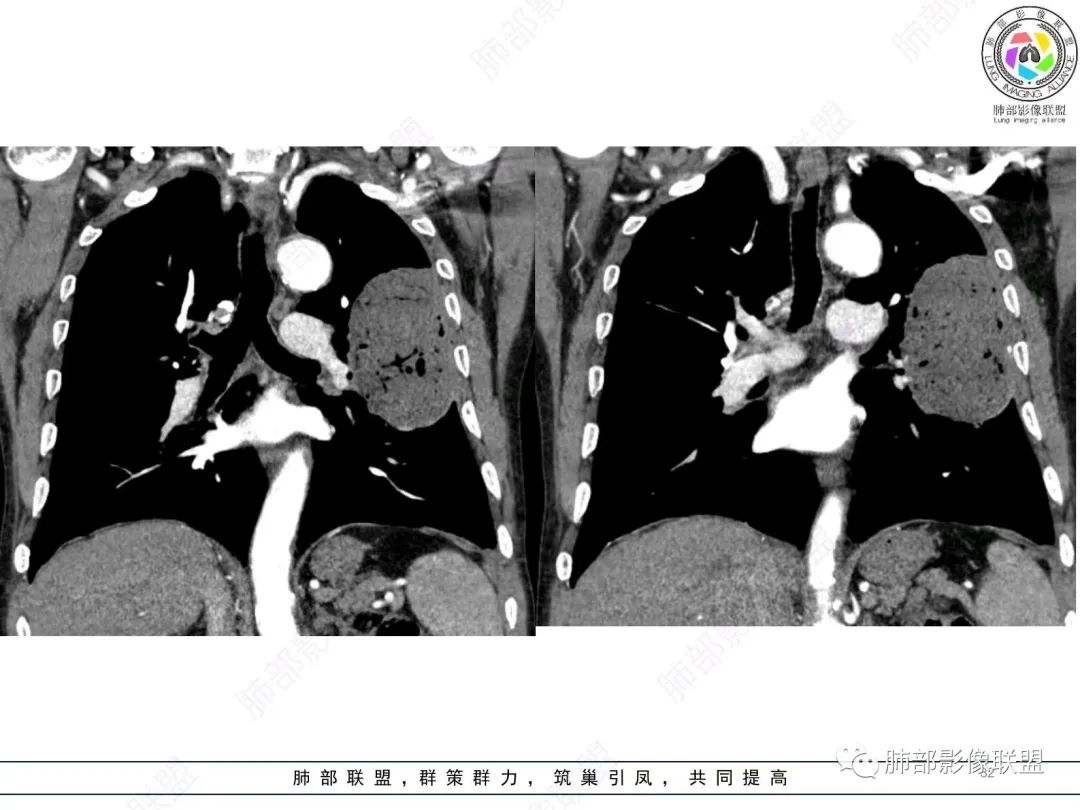 影像PPT - 【病例】肺部硕大块影一定想到它!-31 影像PPT - 【病例】肺部硕大块影一定想到它!-31