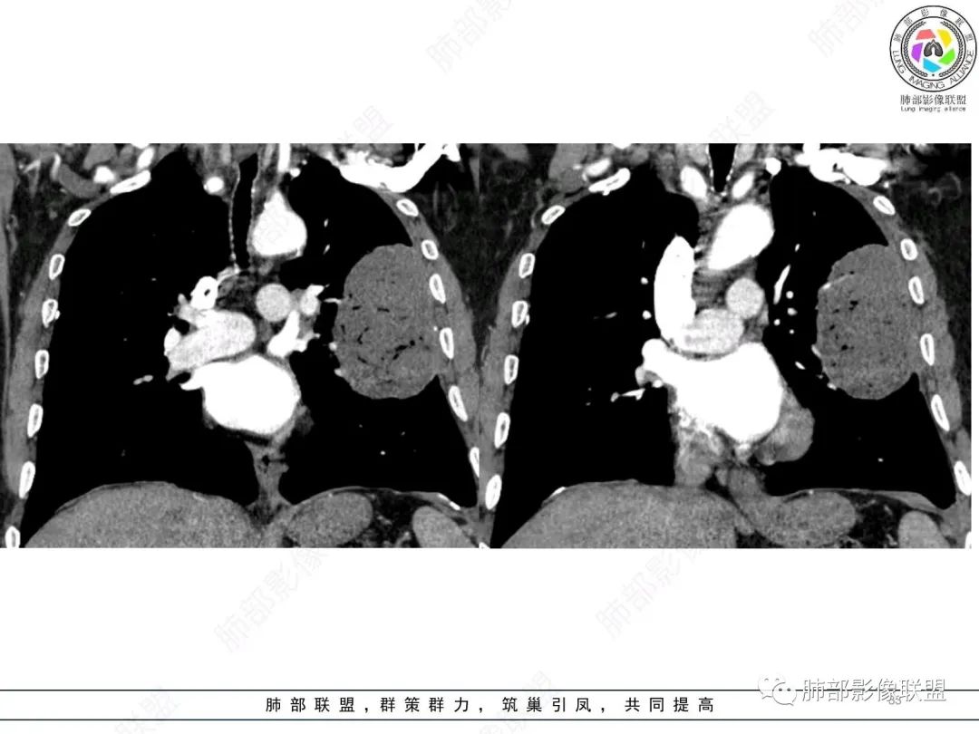 影像PPT - 【病例】肺部硕大块影一定想到它!-32 影像PPT - 【病例】肺部硕大块影一定想到它!-32