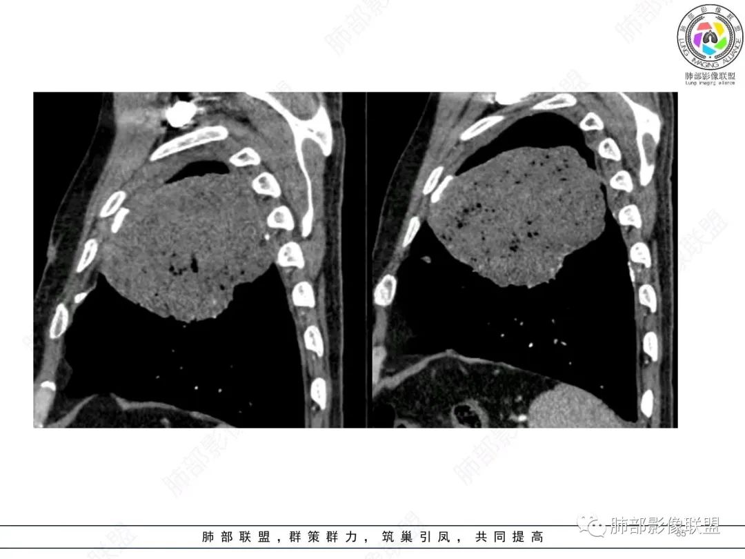 影像PPT - 【病例】肺部硕大块影一定想到它!-34 影像PPT - 【病例】肺部硕大块影一定想到它!-34