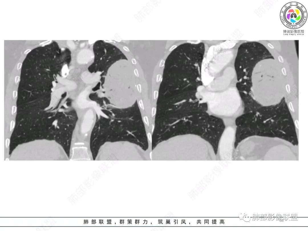 影像PPT - 【病例】肺部硕大块影一定想到它!-37 影像PPT - 【病例】肺部硕大块影一定想到它!-37