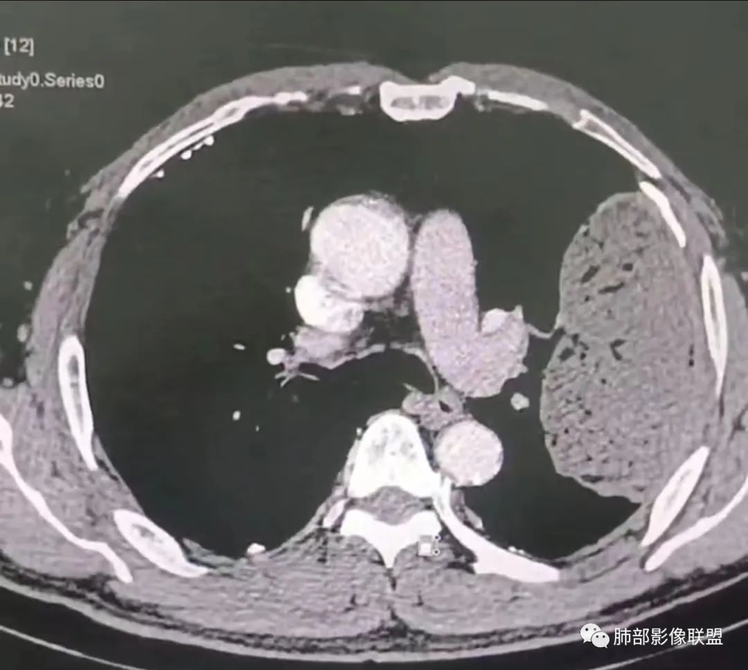 影像PPT - 【病例】肺部硕大块影一定想到它!-39 影像PPT - 【病例】肺部硕大块影一定想到它!-39