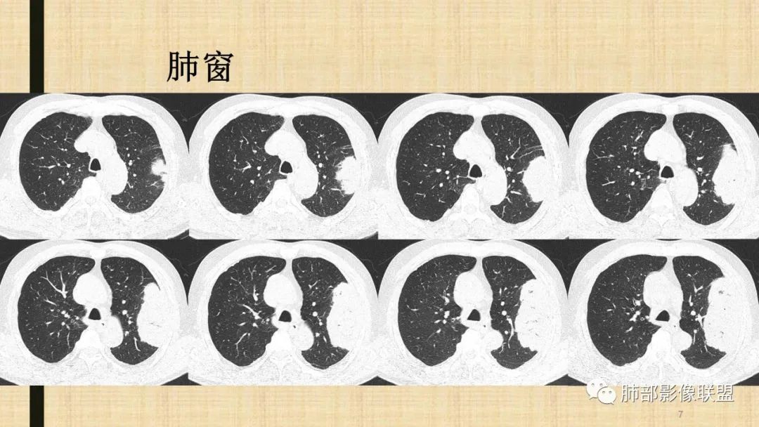 影像PPT - 【病例】肺部硕大块影一定想到它!-64 影像PPT - 【病例】肺部硕大块影一定想到它!-64