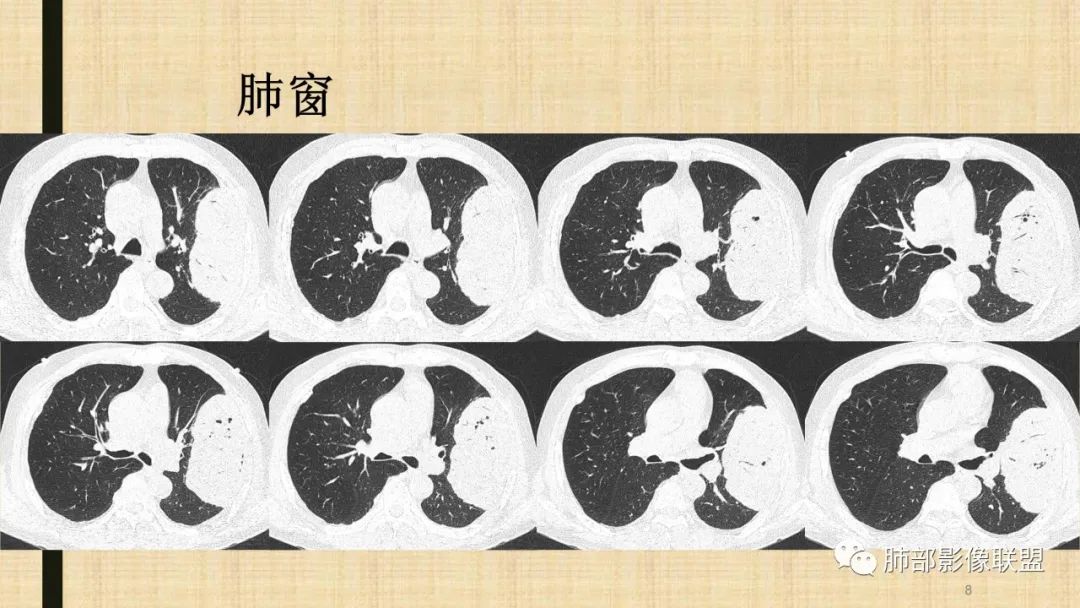 影像PPT - 【病例】肺部硕大块影一定想到它!-65 影像PPT - 【病例】肺部硕大块影一定想到它!-65