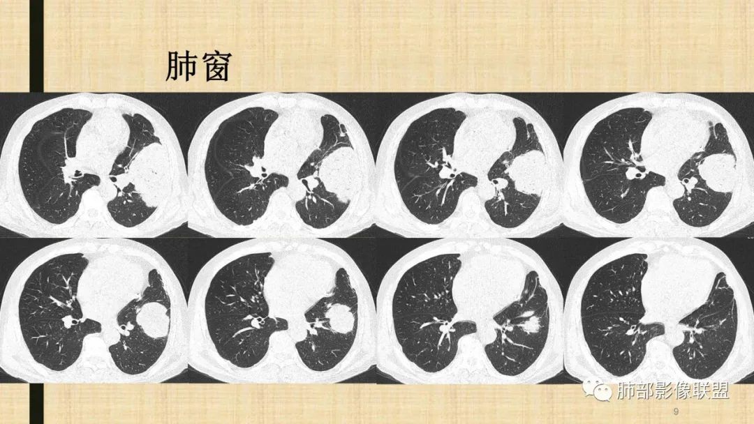 影像PPT - 【病例】肺部硕大块影一定想到它!-66 影像PPT - 【病例】肺部硕大块影一定想到它!-66