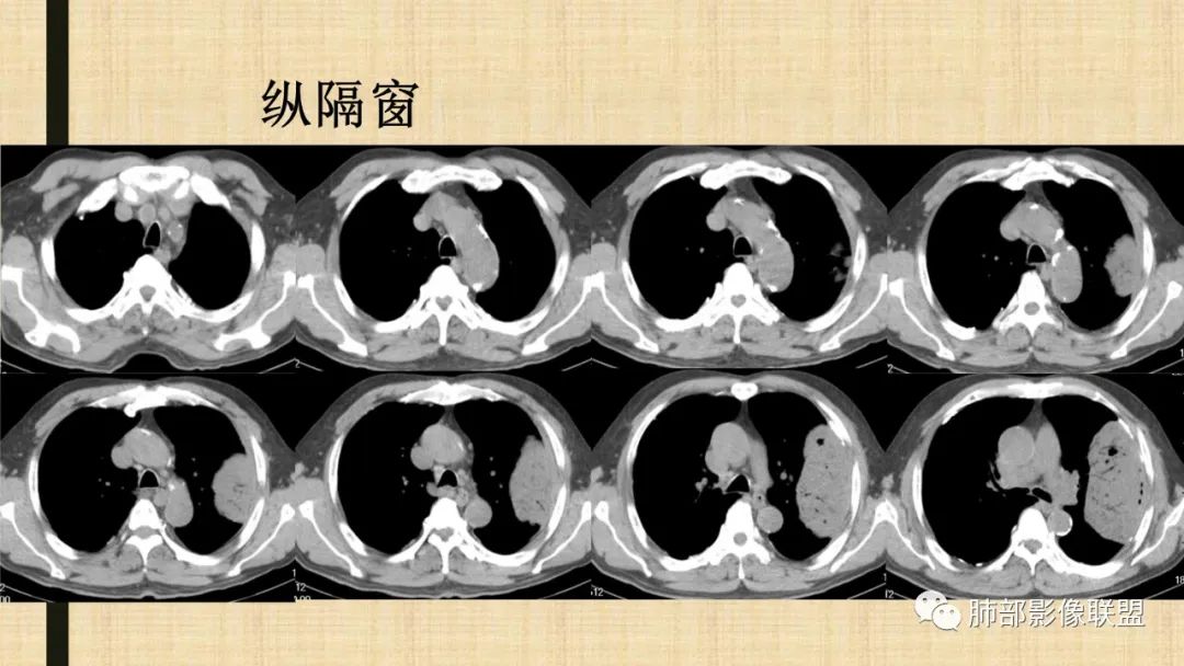 影像PPT - 【病例】肺部硕大块影一定想到它!-67 影像PPT - 【病例】肺部硕大块影一定想到它!-67