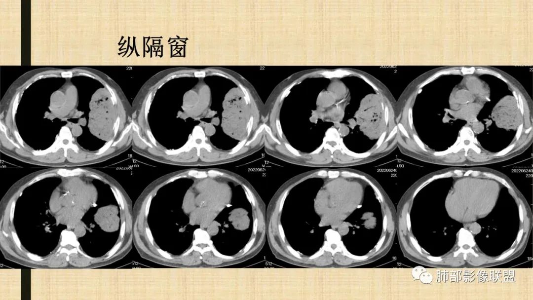 影像PPT - 【病例】肺部硕大块影一定想到它!-68 影像PPT - 【病例】肺部硕大块影一定想到它!-68