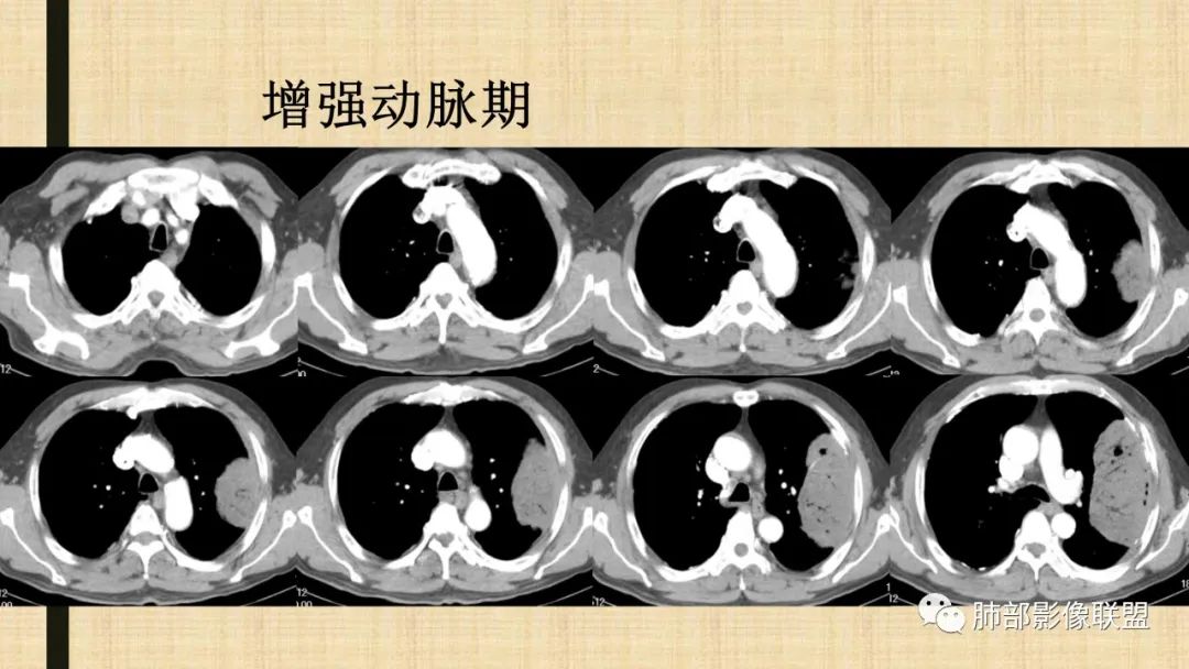 影像PPT - 【病例】肺部硕大块影一定想到它!-69 影像PPT - 【病例】肺部硕大块影一定想到它!-69