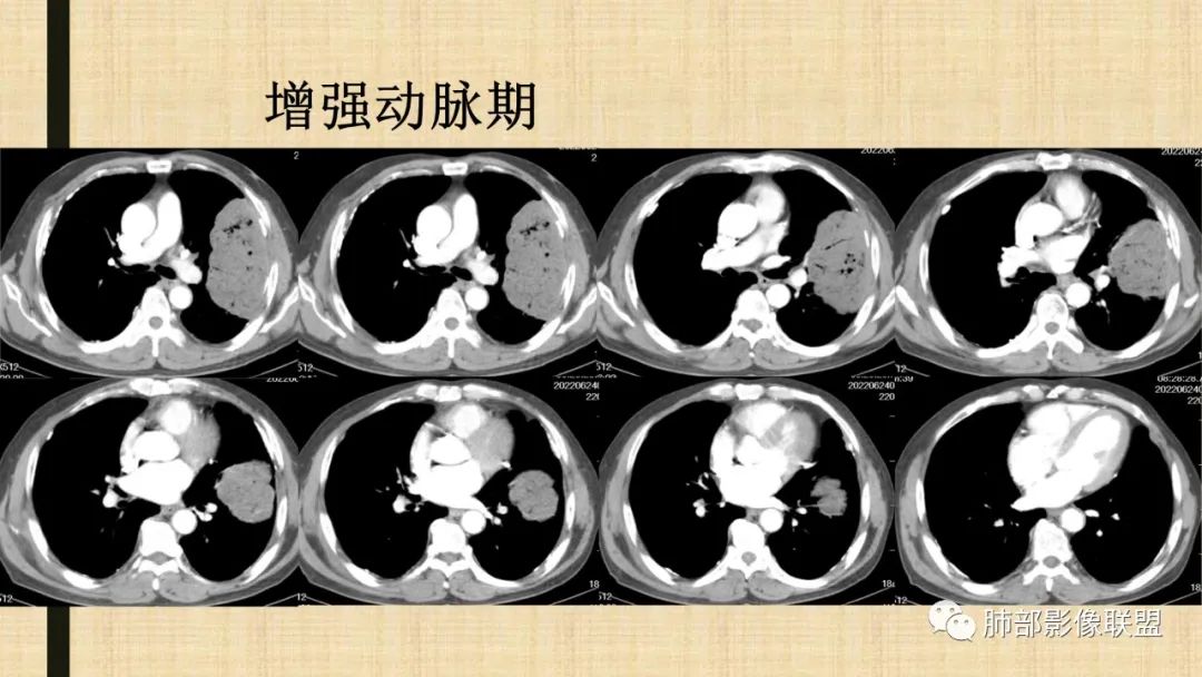 影像PPT - 【病例】肺部硕大块影一定想到它!-70 影像PPT - 【病例】肺部硕大块影一定想到它!-70