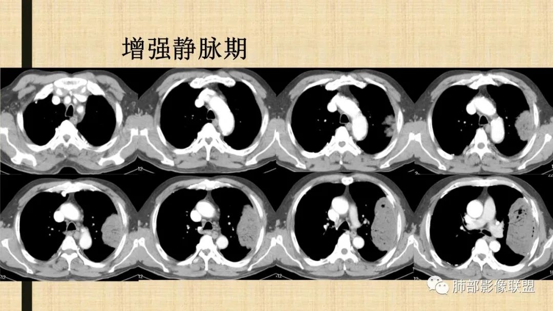 影像PPT - 【病例】肺部硕大块影一定想到它!-71 影像PPT - 【病例】肺部硕大块影一定想到它!-71