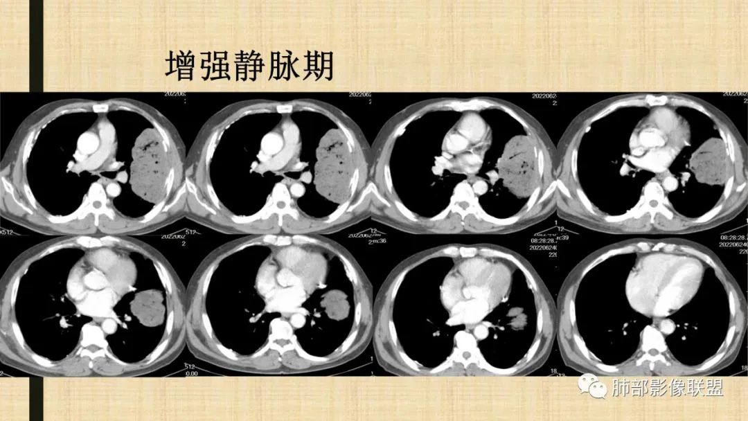 影像PPT - 【病例】肺部硕大块影一定想到它!-72 影像PPT - 【病例】肺部硕大块影一定想到它!-72