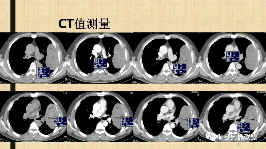 影像PPT - 【病例】肺部硕大块影一定想到它!-73 影像PPT - 【病例】肺部硕大块影一定想到它!-73