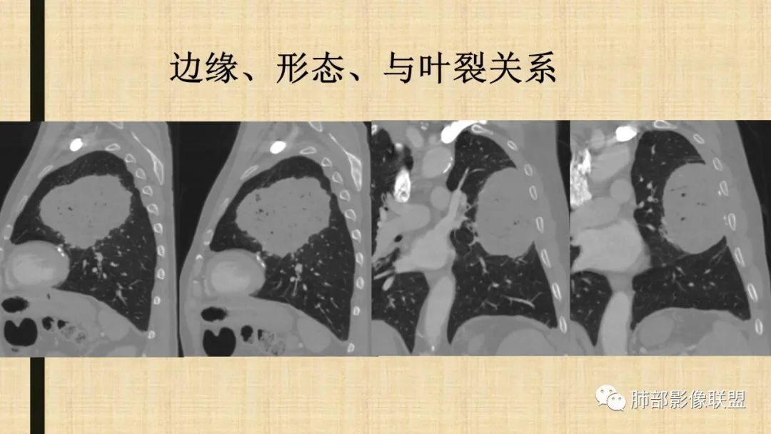 影像PPT - 【病例】肺部硕大块影一定想到它!-74 影像PPT - 【病例】肺部硕大块影一定想到它!-74