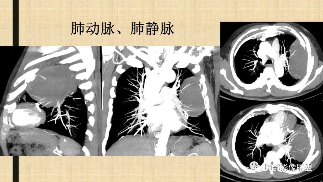 影像PPT - 【病例】肺部硕大块影一定想到它!-75 影像PPT - 【病例】肺部硕大块影一定想到它!-75