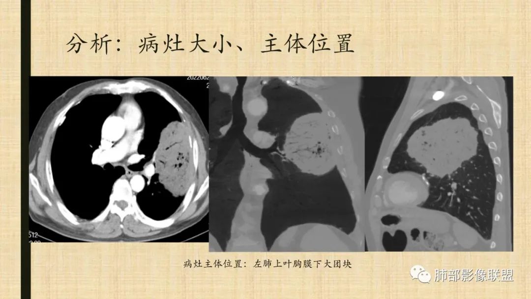 影像PPT - 【病例】肺部硕大块影一定想到它!-77 影像PPT - 【病例】肺部硕大块影一定想到它!-77