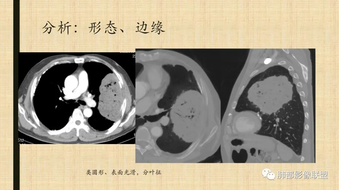 影像PPT - 【病例】肺部硕大块影一定想到它!-78 影像PPT - 【病例】肺部硕大块影一定想到它!-78