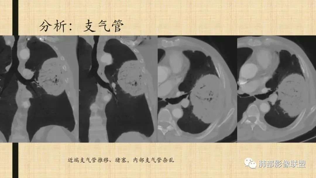 影像PPT - 【病例】肺部硕大块影一定想到它!-79 影像PPT - 【病例】肺部硕大块影一定想到它!-79