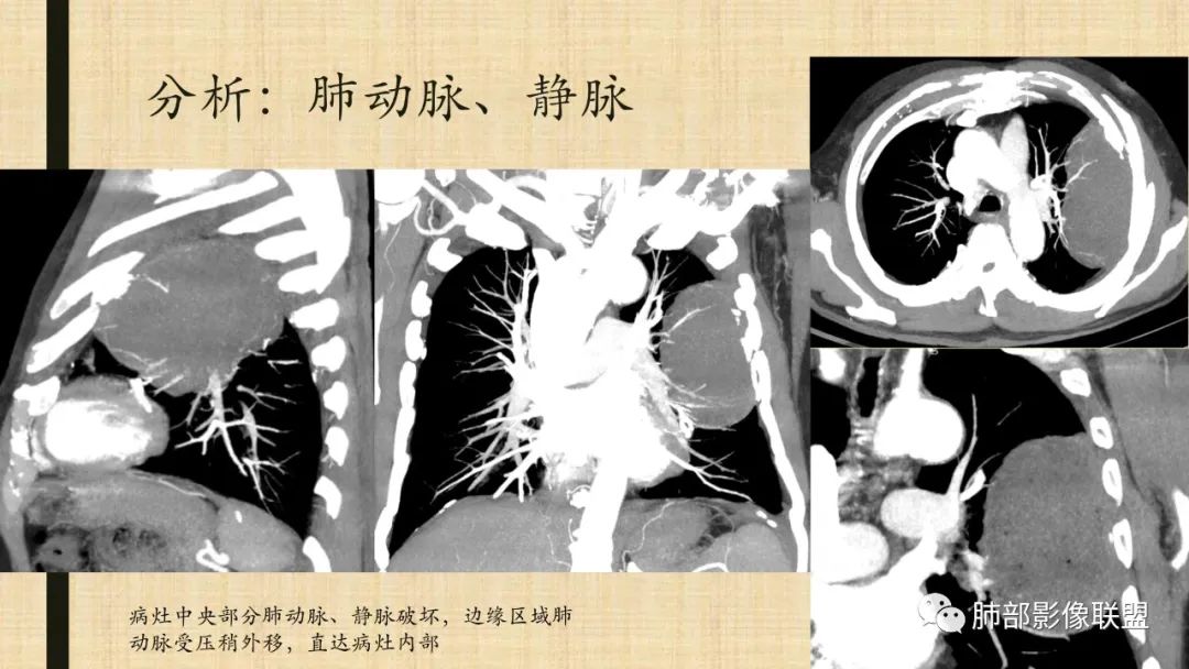 影像PPT - 【病例】肺部硕大块影一定想到它!-80 影像PPT - 【病例】肺部硕大块影一定想到它!-80