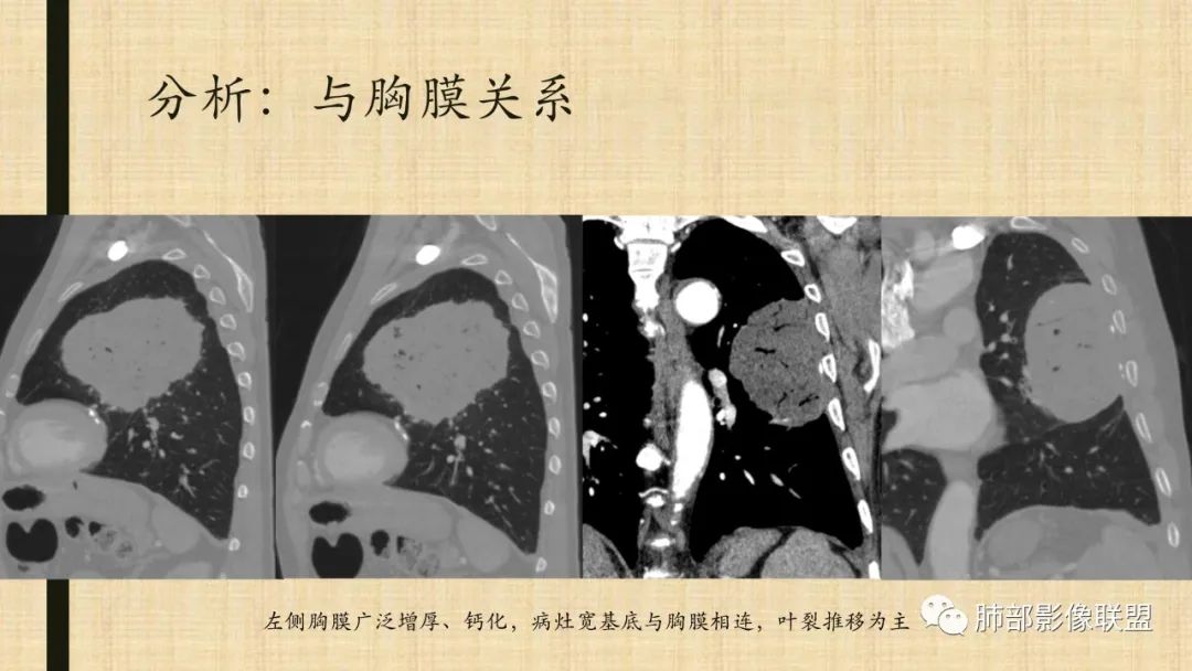 影像PPT - 【病例】肺部硕大块影一定想到它!-81 影像PPT - 【病例】肺部硕大块影一定想到它!-81