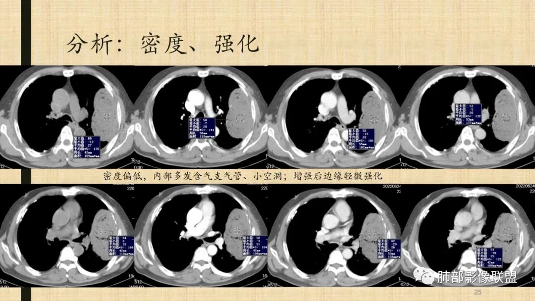 影像PPT - 【病例】肺部硕大块影一定想到它!-82 影像PPT - 【病例】肺部硕大块影一定想到它!-82
