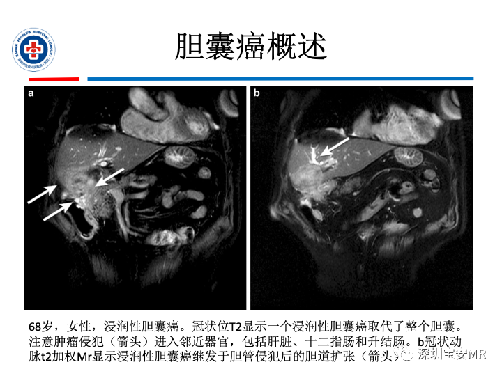 影像PPT - 【PPT】胆囊癌及其MRI上的鉴别诊断-13