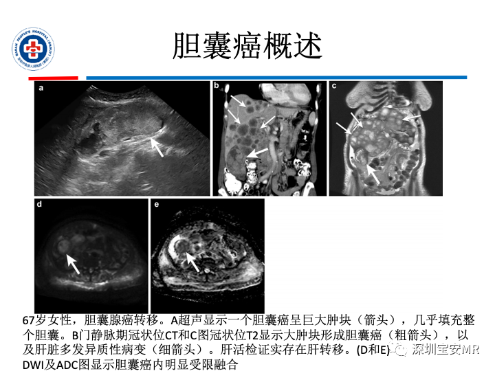 影像PPT - 【PPT】胆囊癌及其MRI上的鉴别诊断-14