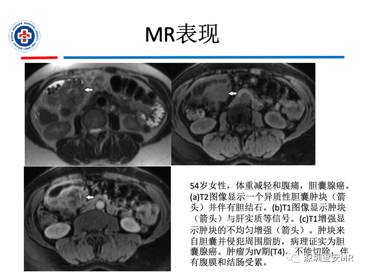 影像PPT - 【PPT】胆囊癌及其MRI上的鉴别诊断-18