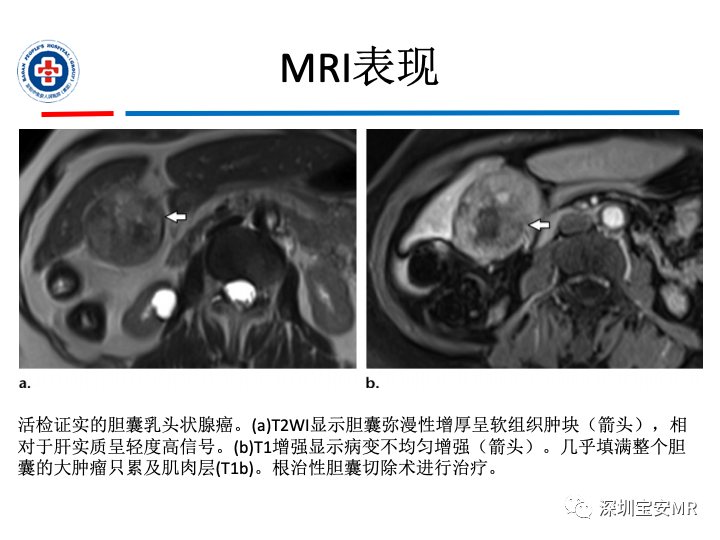 影像PPT - 【PPT】胆囊癌及其MRI上的鉴别诊断-19
