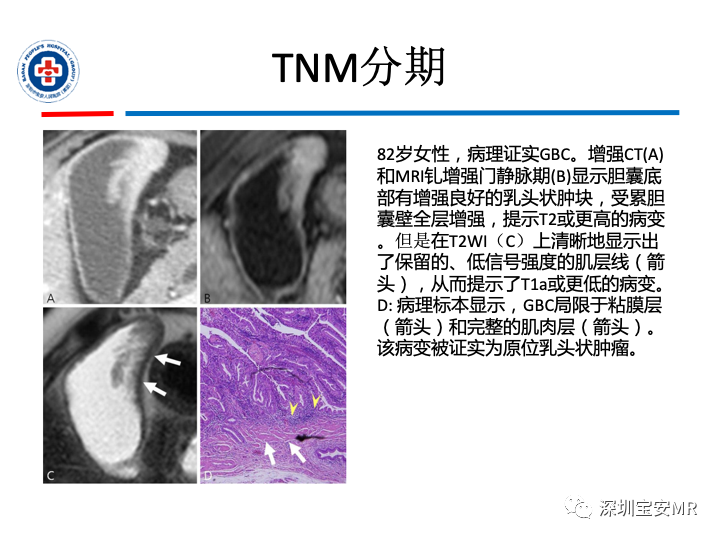 影像PPT - 【PPT】胆囊癌及其MRI上的鉴别诊断-23