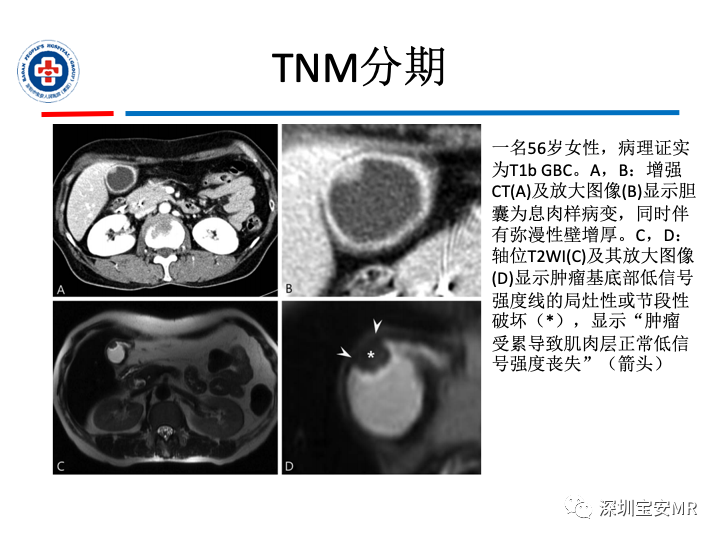 影像PPT - 【PPT】胆囊癌及其MRI上的鉴别诊断-24