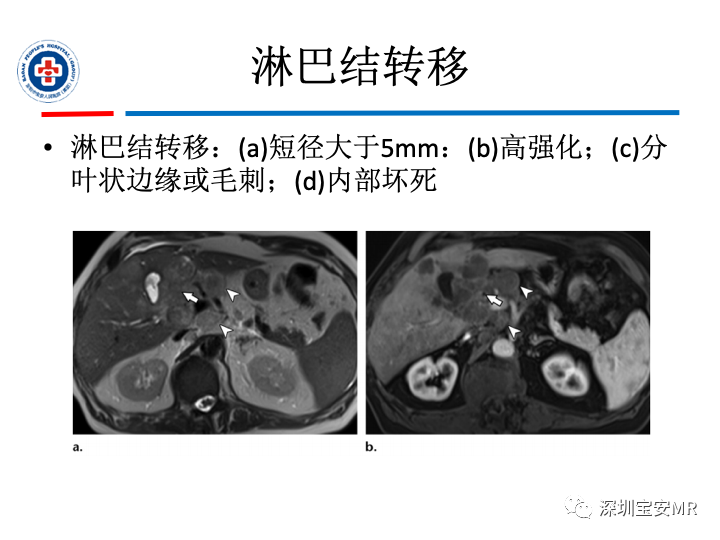 影像PPT - 【PPT】胆囊癌及其MRI上的鉴别诊断-30