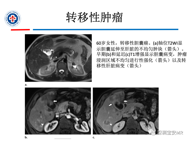 影像PPT - 【PPT】胆囊癌及其MRI上的鉴别诊断-34