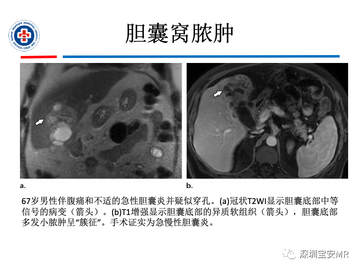 影像PPT - 【PPT】胆囊癌及其MRI上的鉴别诊断-35