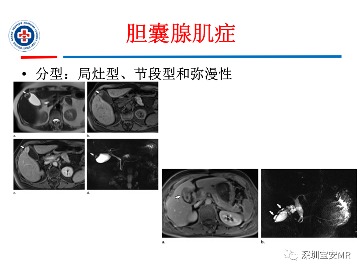 影像PPT - 【PPT】胆囊癌及其MRI上的鉴别诊断-37