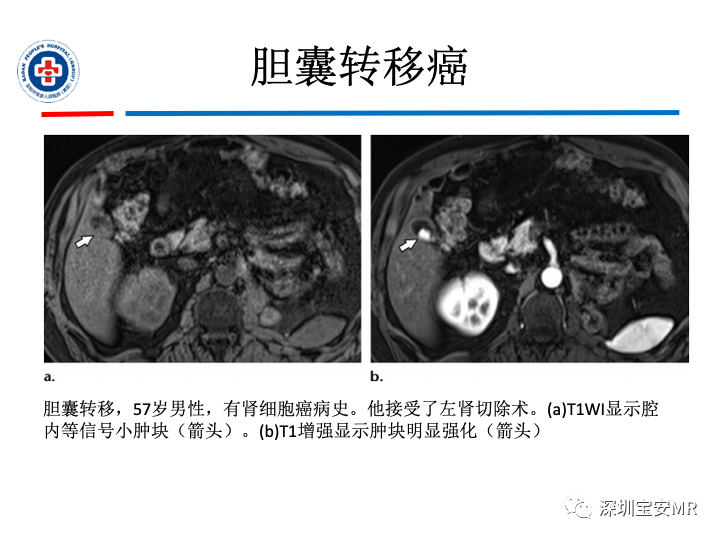 影像PPT - 【PPT】胆囊癌及其MRI上的鉴别诊断-41