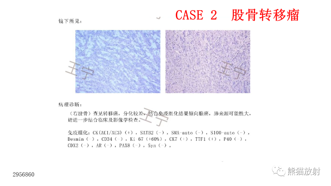 影像PPT - 【病例】股骨淋巴瘤 VS 股骨转移瘤-13