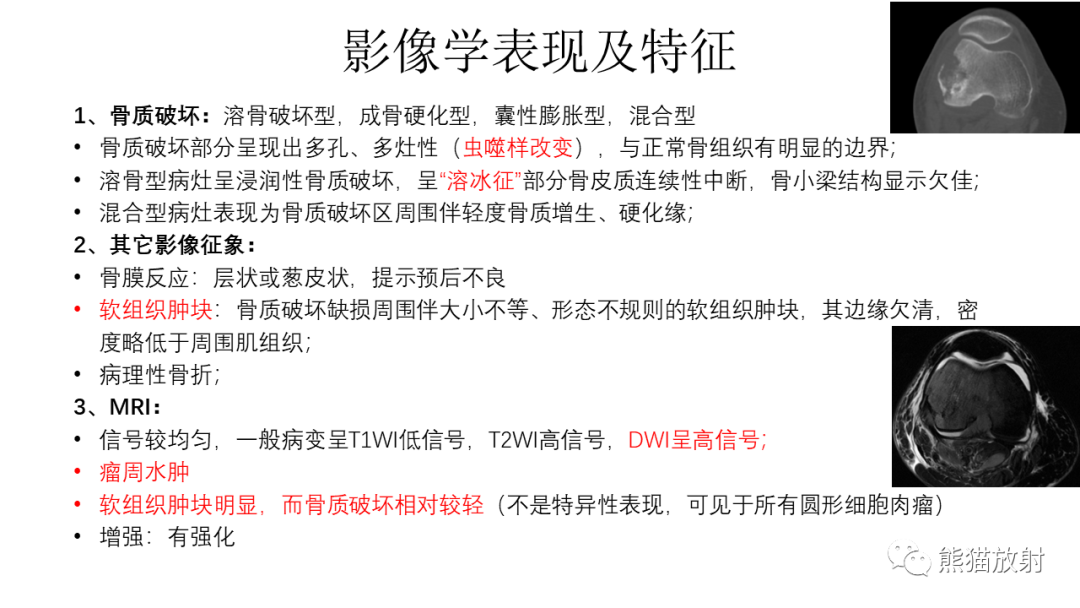 影像PPT - 【病例】股骨淋巴瘤 VS 股骨转移瘤-18