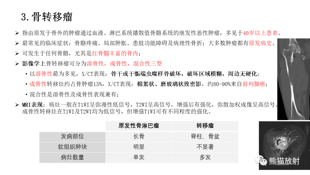影像PPT - 【病例】股骨淋巴瘤 VS 股骨转移瘤-37