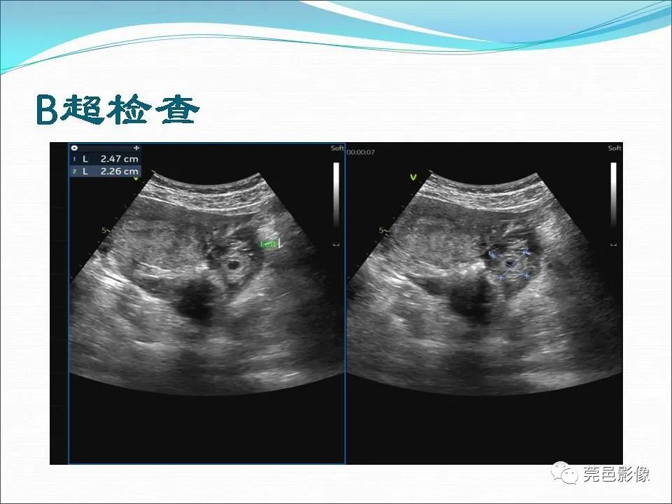 影像PPT - 【病例】输卵管妊娠破裂1例B超及CT影像-4