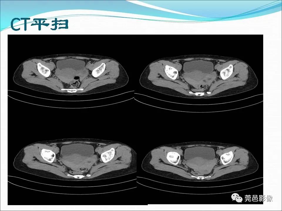 影像PPT - 【病例】输卵管妊娠破裂1例B超及CT影像-5