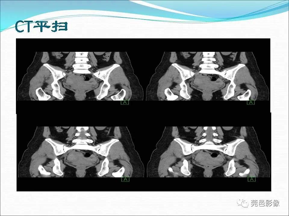 影像PPT - 【病例】输卵管妊娠破裂1例B超及CT影像-6