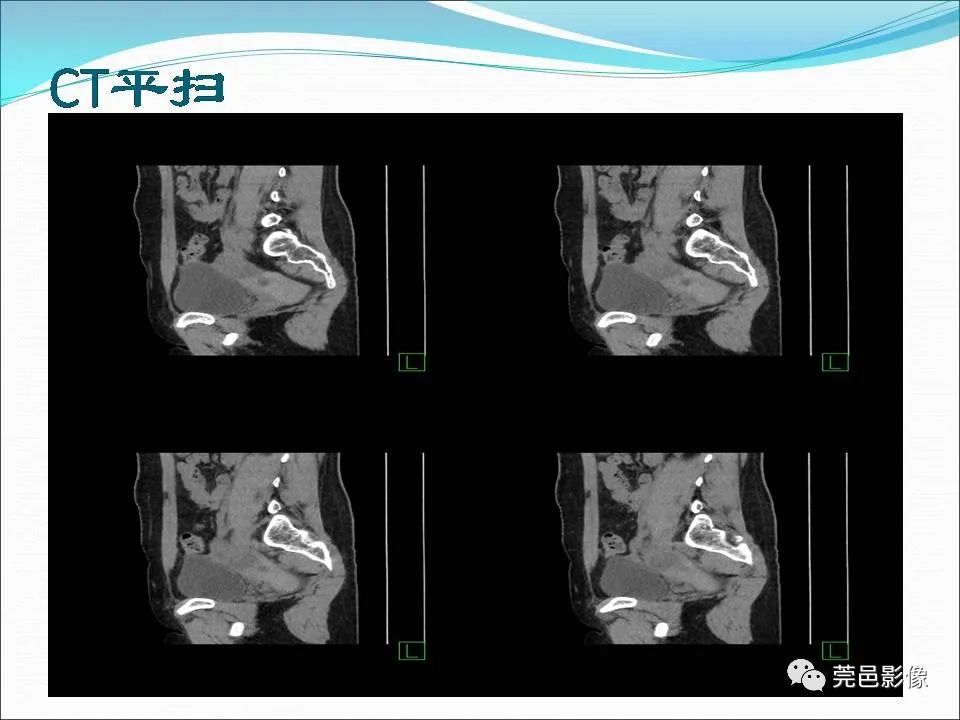 影像PPT - 【病例】输卵管妊娠破裂1例B超及CT影像-7