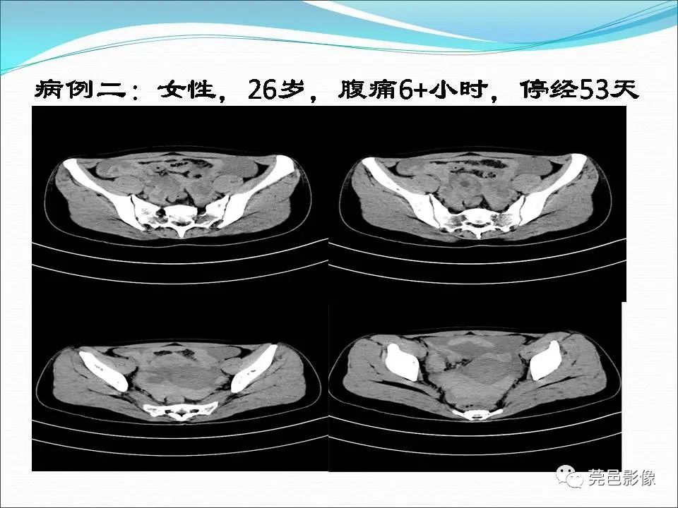 影像PPT - 【病例】输卵管妊娠破裂1例B超及CT影像-11