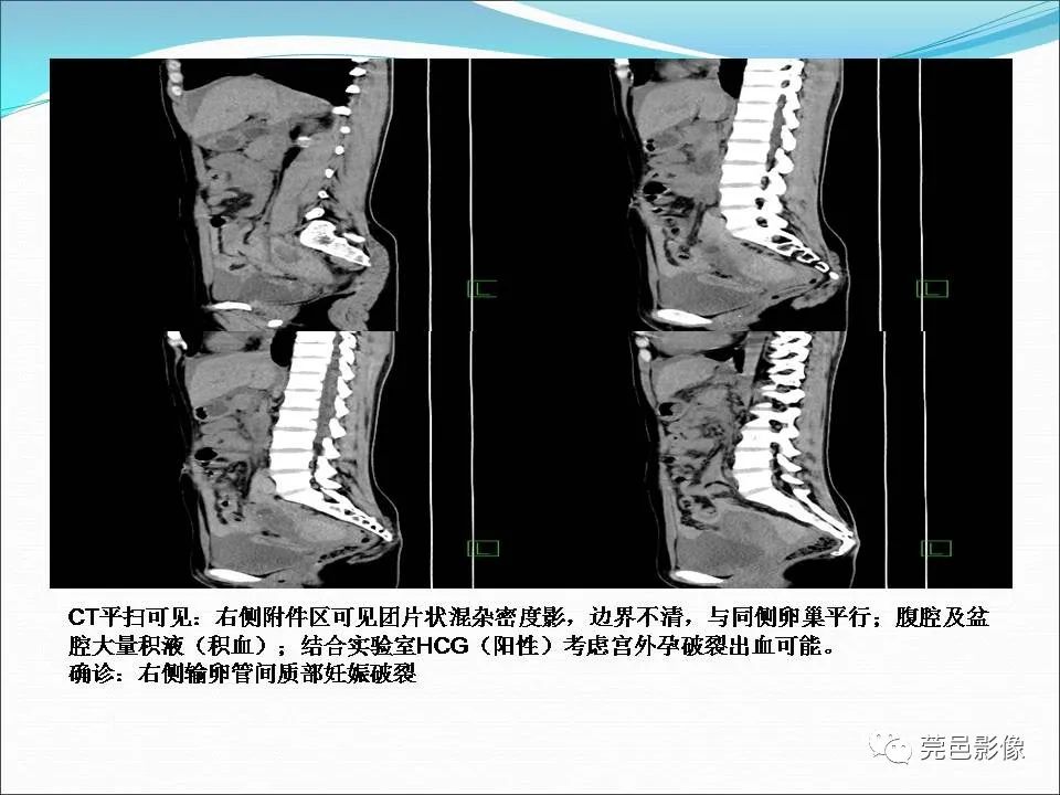 影像PPT - 【病例】输卵管妊娠破裂1例B超及CT影像-13