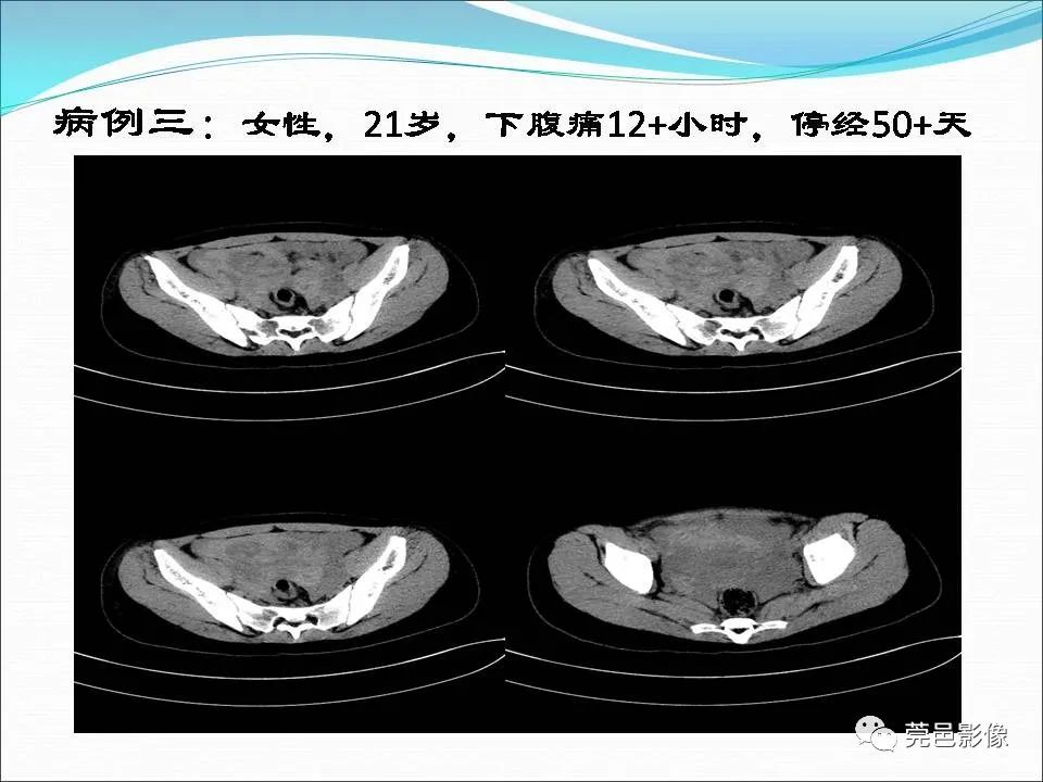 影像PPT - 【病例】输卵管妊娠破裂1例B超及CT影像-14