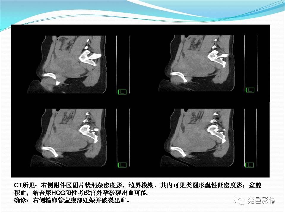 影像PPT - 【病例】输卵管妊娠破裂1例B超及CT影像-16