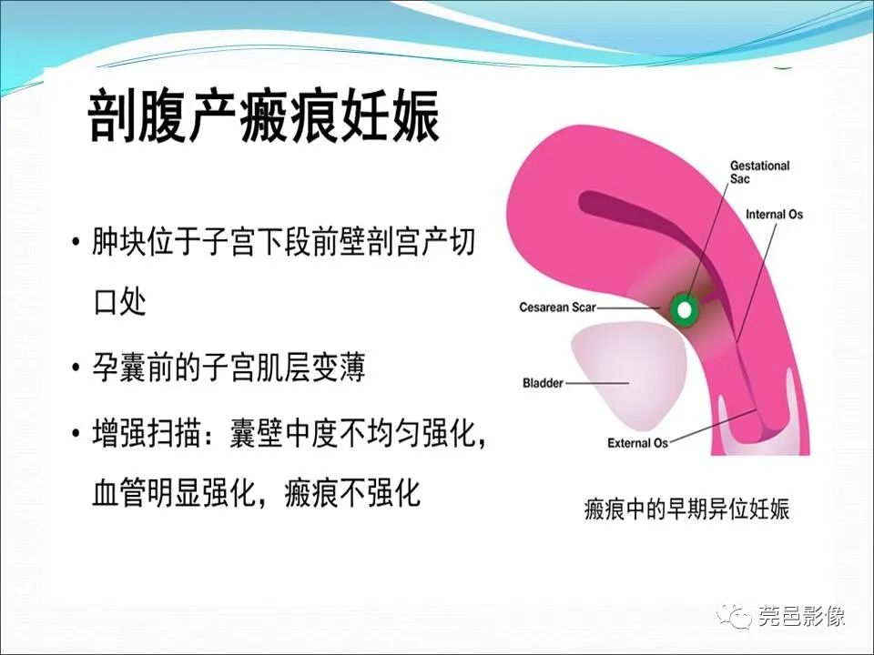 影像PPT - 【病例】输卵管妊娠破裂1例B超及CT影像-26