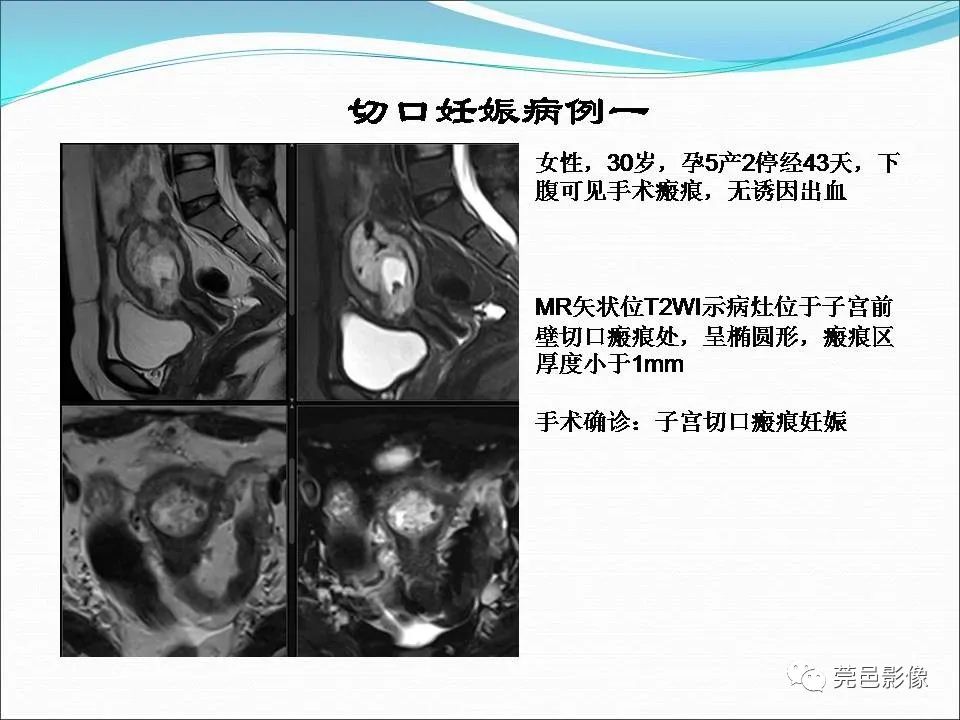 影像PPT - 【病例】输卵管妊娠破裂1例B超及CT影像-27